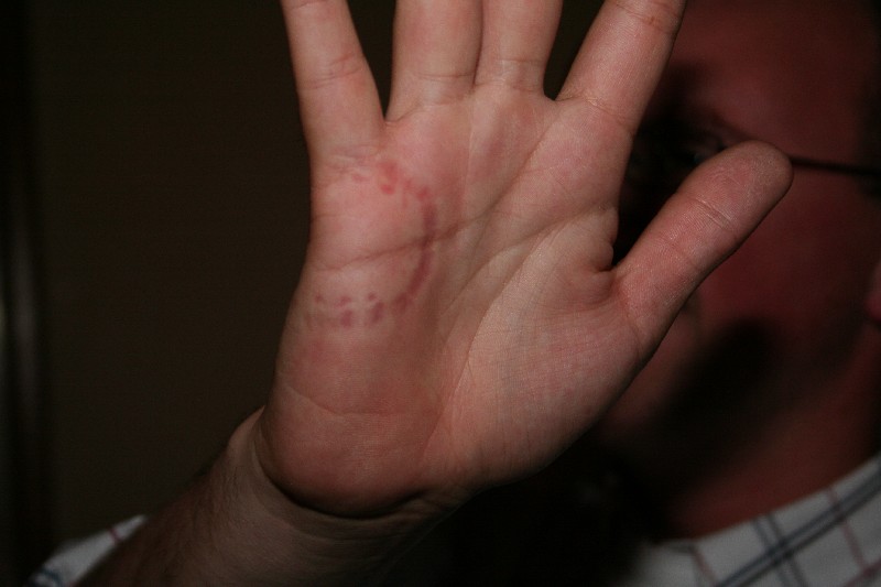 dakkus left his imprints on giberski's hand
